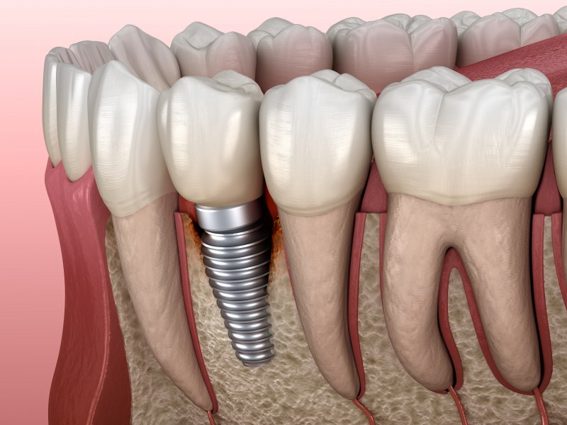 Implantology