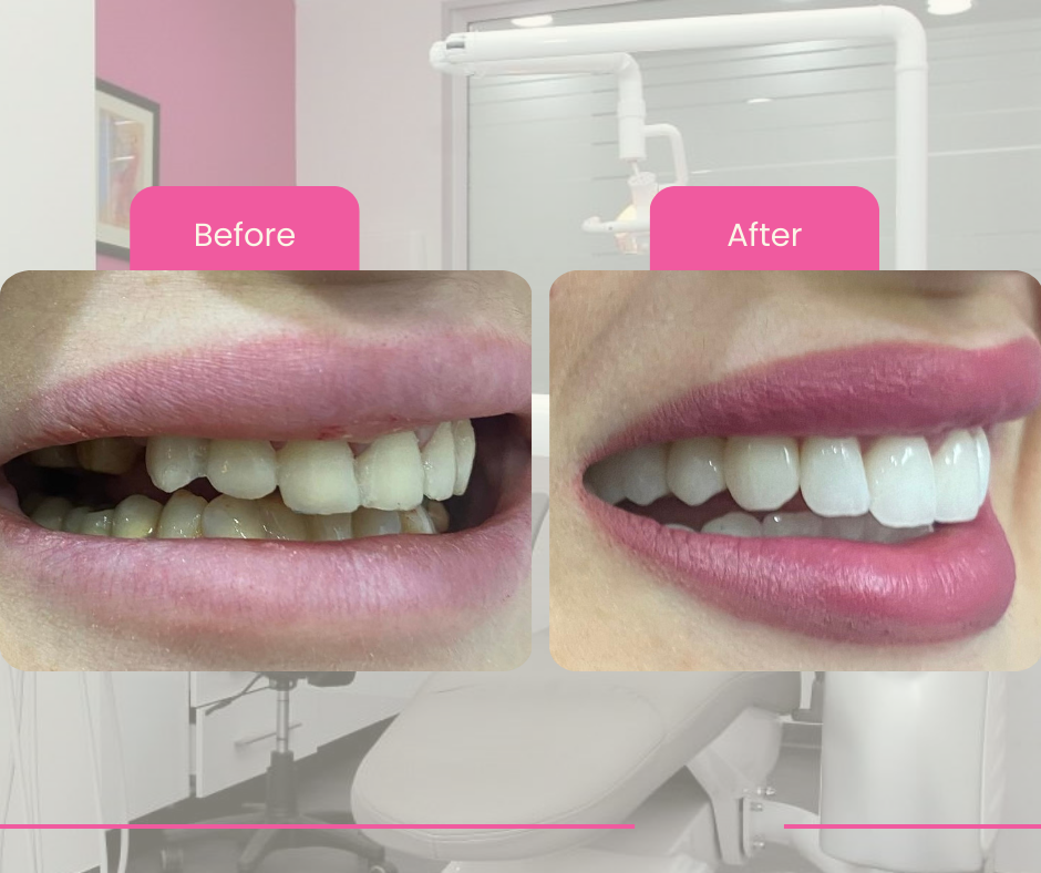 Ceramic veneers