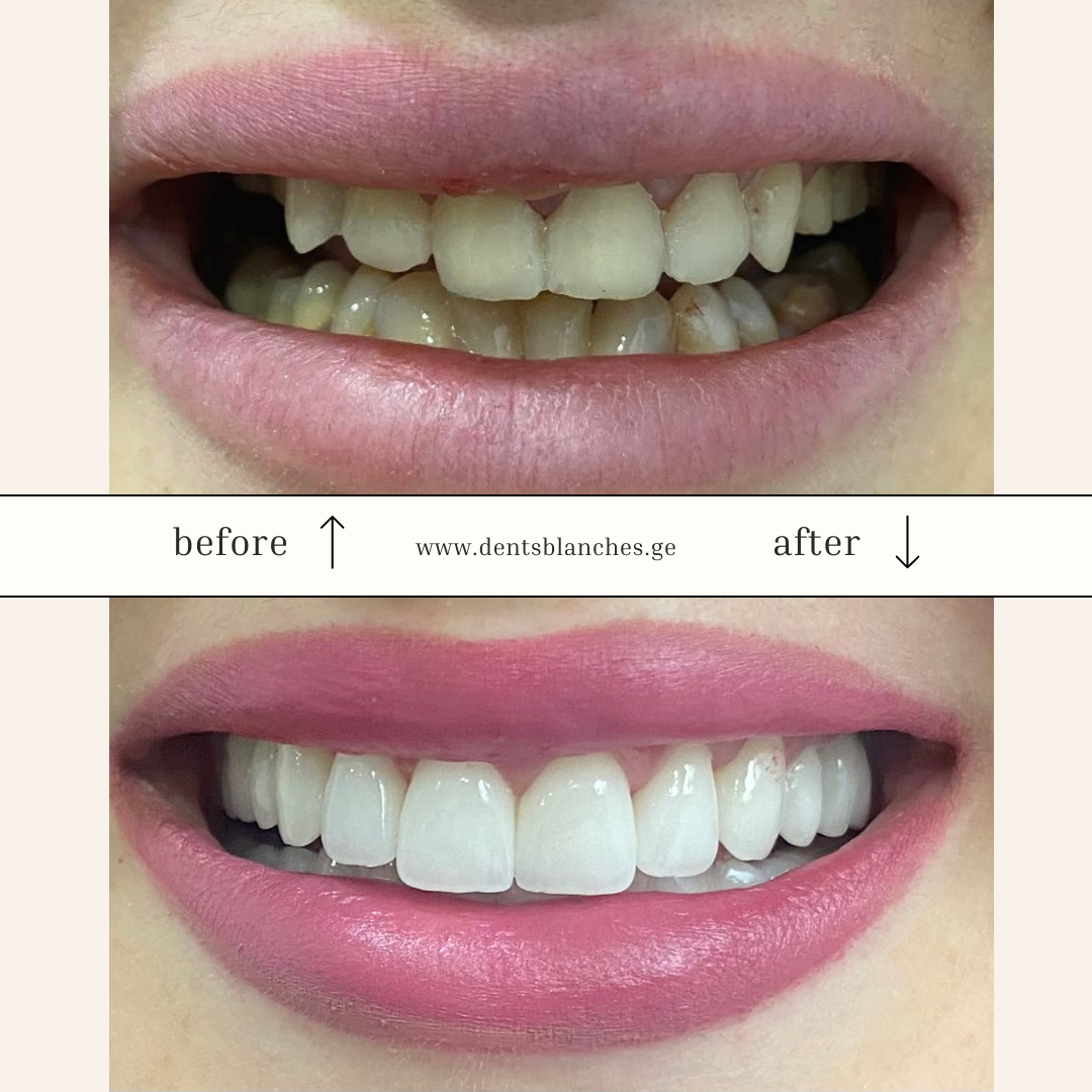 Ceramic veneers